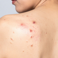 Acne Control Body Spray